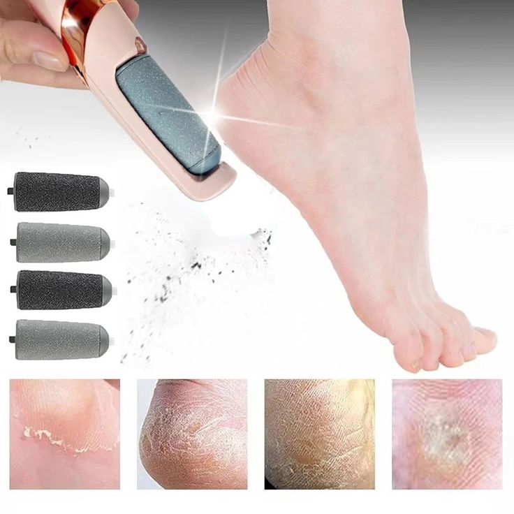 Electric Foot Callus Remover
